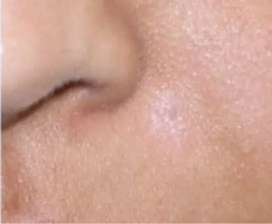 Ear Lobe Repair after (1)