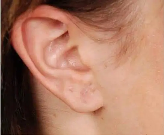 Ear Lobe Repair after (1)
