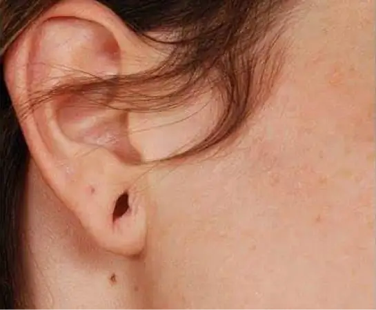 Ear Lobe Repair before (1)