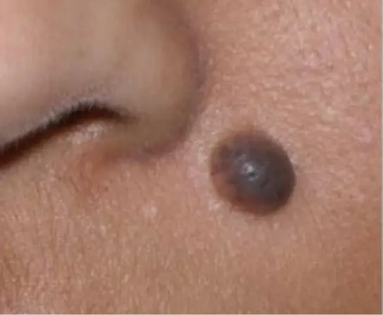 Mole Removal before (1)
